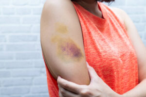 Bruises on a woman's arm